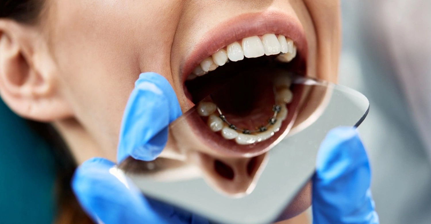 What are inner teeth braces Inblog